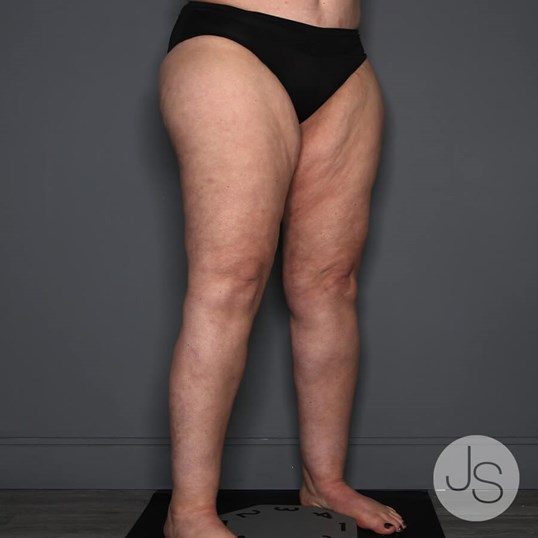 Lipedema Before and After Pictures Beverly Hills, CA