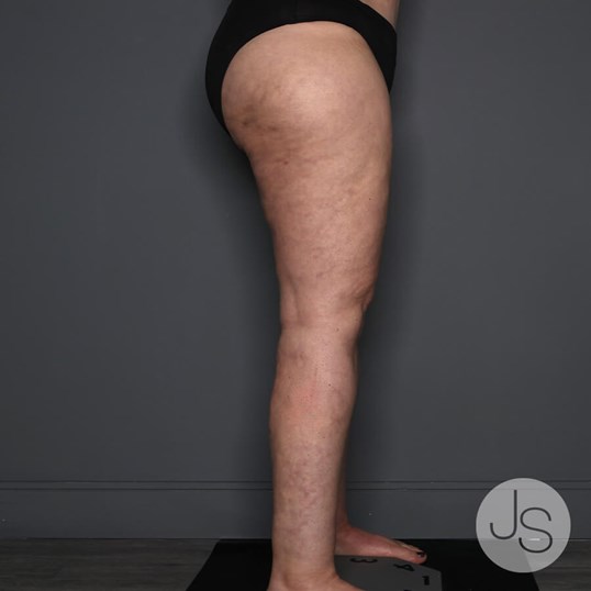 Lipedema Before and After Pictures Beverly Hills, CA