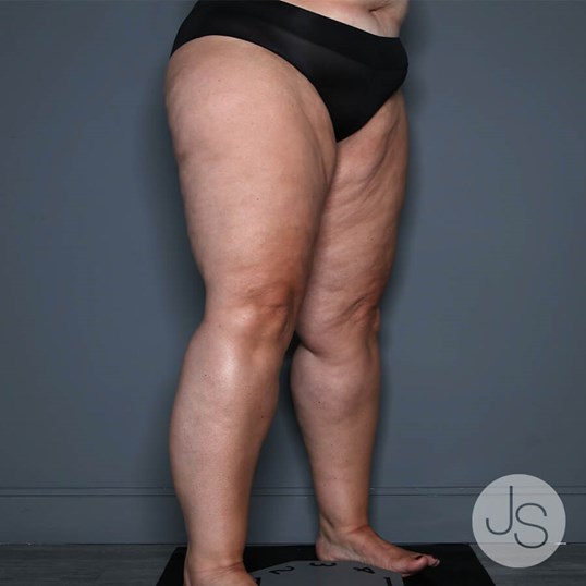 Lipedema Before and After Pictures Beverly Hills, CA