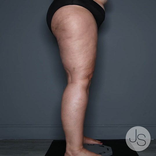 Lipedema Before and After Pictures Beverly Hills, CA