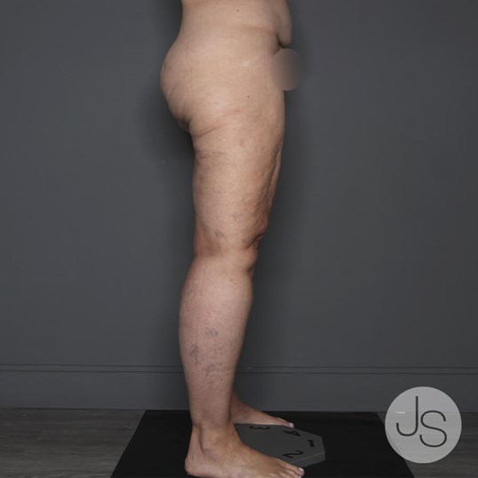 Lipedema Before and After Pictures Beverly Hills, CA