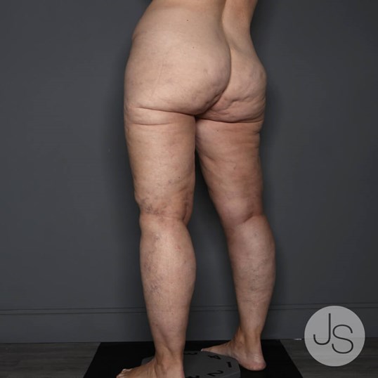 Lipedema Before and After Pictures Beverly Hills, CA