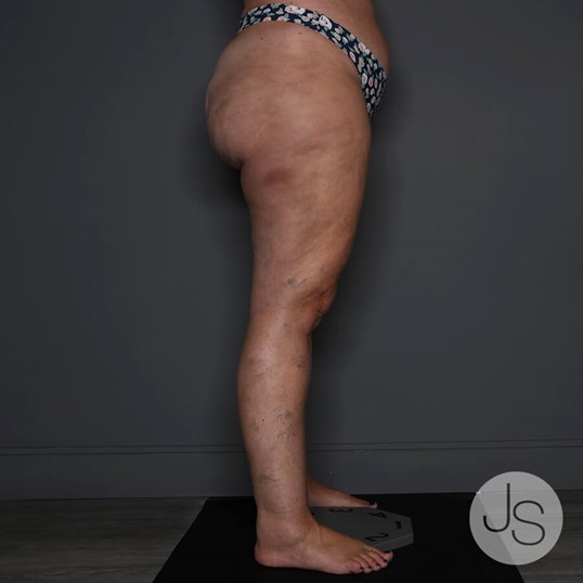 Lipedema Before and After Pictures Beverly Hills, CA