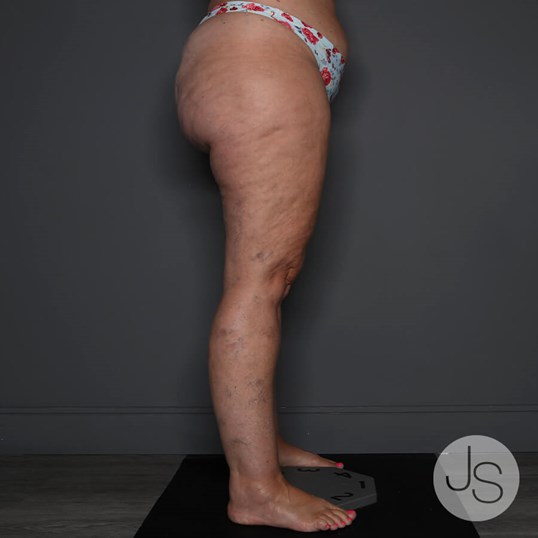 Lipedema Before and After Pictures Beverly Hills, CA