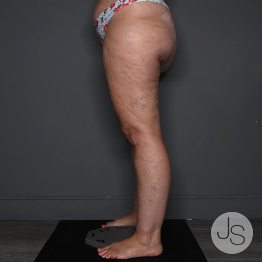 Lipedema Before and After Pictures Beverly Hills, CA