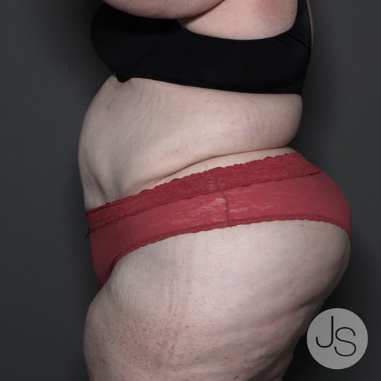 Lipedema Before and After Pictures Beverly Hills, CA