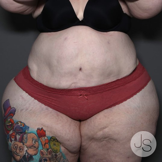 Lipedema Before and After Pictures Beverly Hills, CA