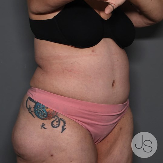 Lipedema Before and After Pictures Beverly Hills, CA