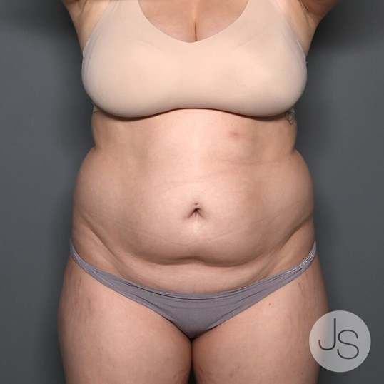 Renuvion (J-Plasma) Before and After Pictures Beverly Hills, CA