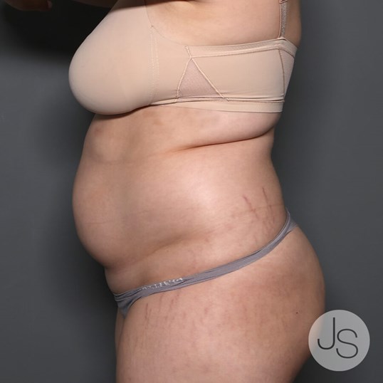 Renuvion (J-Plasma) Before and After Pictures Beverly Hills, CA