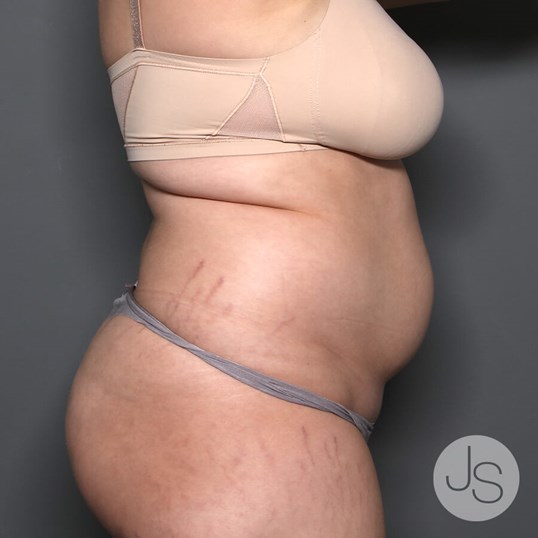 Renuvion (J-Plasma) Before and After Pictures Beverly Hills, CA