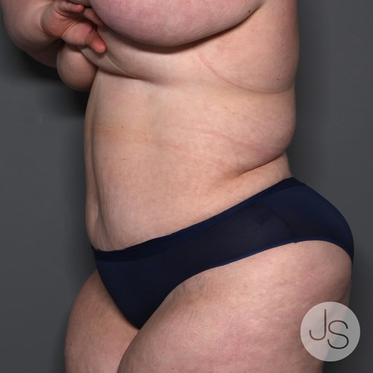 Lipedema Before and After Pictures Beverly Hills, CA