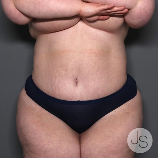 Lipedema Before and After Pictures Beverly Hills, CA