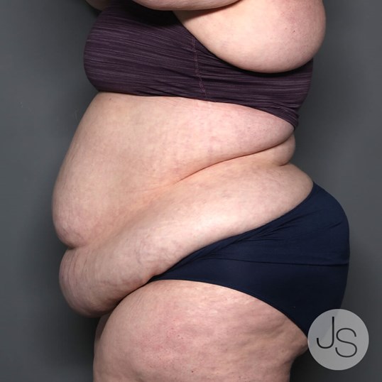 Lipedema Before and After Pictures Beverly Hills, CA