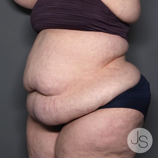 Lipedema Before and After Pictures Beverly Hills, CA