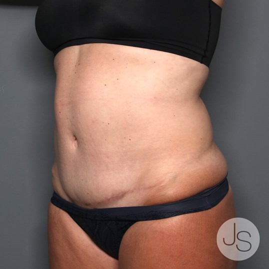 Renuvion (J-Plasma) Before and After Pictures Beverly Hills, CA