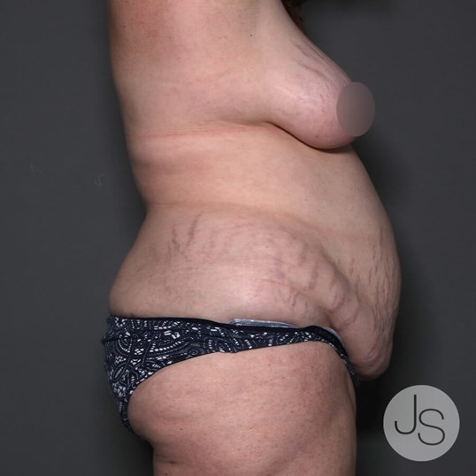 Lipedema Before and After Pictures Beverly Hills, CA