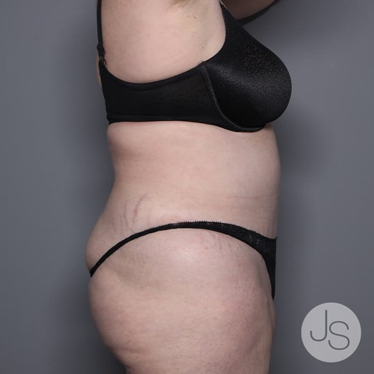 Lipedema Before and After Pictures Beverly Hills, CA