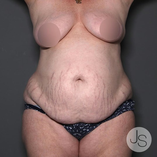 Lipedema Before and After Pictures Beverly Hills, CA