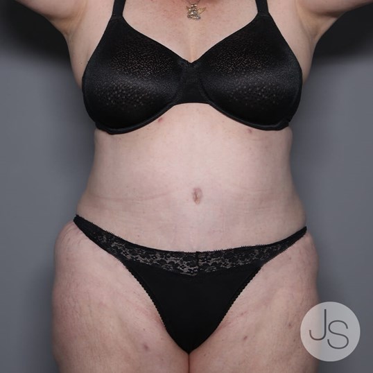 Lipedema Before and After Pictures Beverly Hills, CA