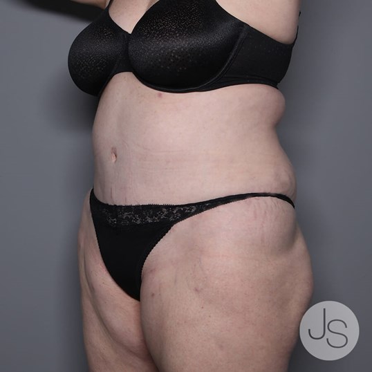 Lipedema Before and After Pictures Beverly Hills, CA