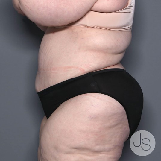 Lipedema Before and After Pictures Beverly Hills, CA