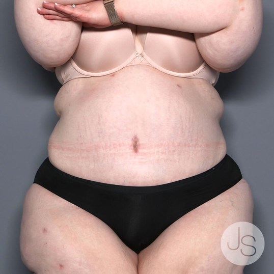 Lipedema Before and After Pictures Beverly Hills, CA